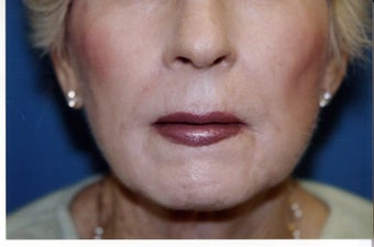 Direct Lip Lift after 409914