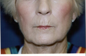 Direct Lip Lift before 409914