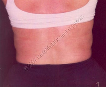 LipoDissolve injections to back fat after 9739