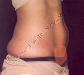 LipoDissolve injections to belly fat & love handles before 9738