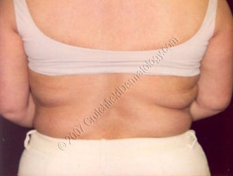 LipoDissolve injections to back fat before 9739