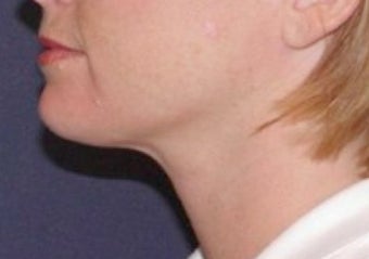Neck lipo after 374872