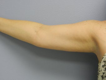 Before Laser Lipo / Arms after 382290