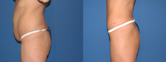 liposculpture after 401874