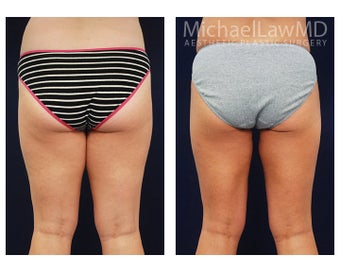 Liposuction after 495064