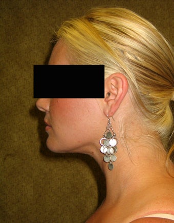 liposuction of neck & jaw line for women after 583584