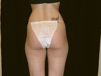 Liposuction before 236060