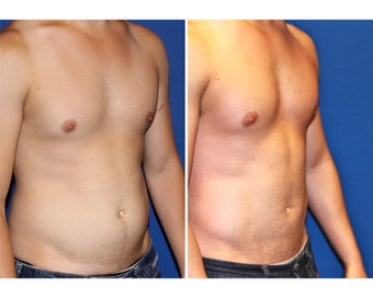 Liposculpture before 331143
