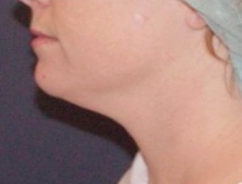 Neck lipo before 374872