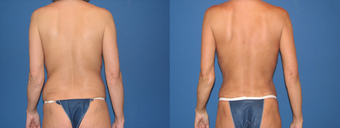 liposculpture before 401874