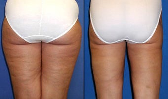 Liposuction before 476159