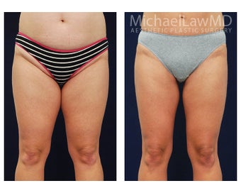 Liposuction before 495064