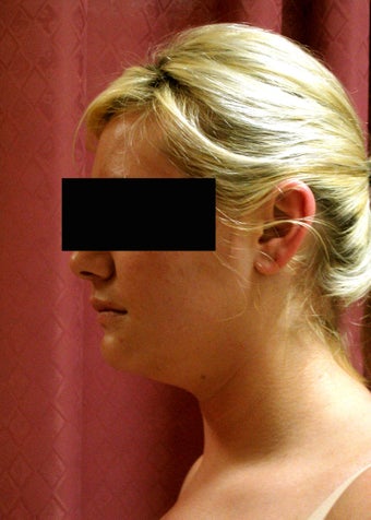 liposuction of neck & jaw line for women before 583584