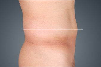 Liposonix after 476123