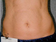 Liposonix after 582693