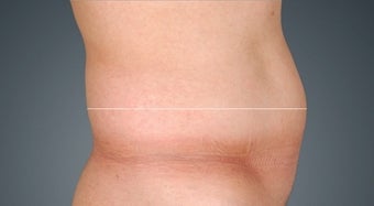 Liposonix before 476123