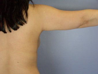 Liposuction of the arms after 306403
