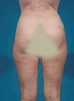 Liposuction after 372146