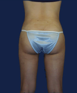 liposuction after 476620