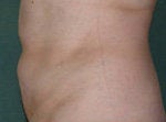 Lipo to Tummy after 478021