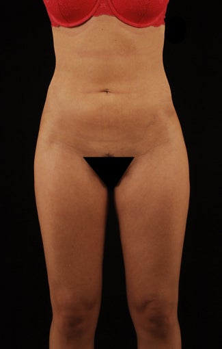 Liposuction after 512878