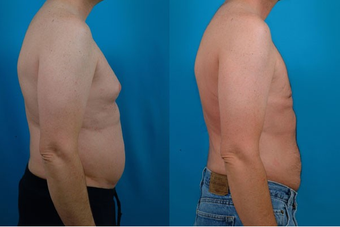 Liposuction after 574562