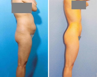 Liposuction before 278760
