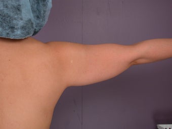Liposuction of the arms before 306403