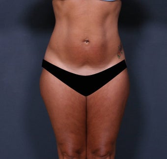 Liposuction before 371112