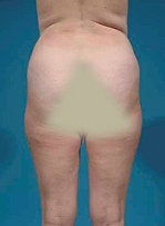 Liposuction before 372146