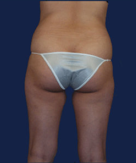 liposuction before 476620