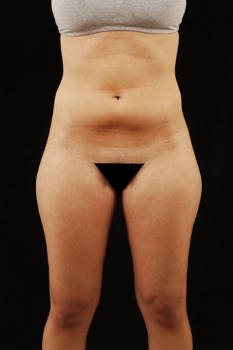Liposuction before 512878