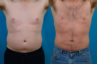 Liposuction before 574562