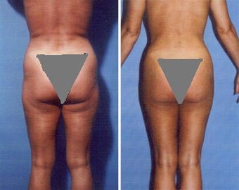 Liposuction before 636100