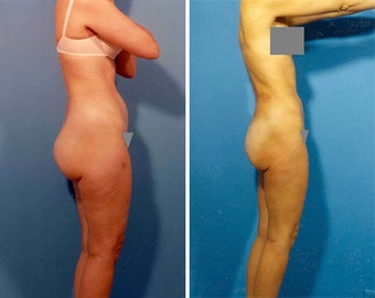Liposuction before 636122