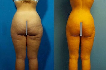 Liposuction before 636250