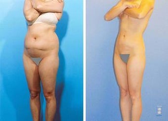 Liposuction before 636258
