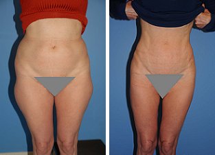 Liposuction before 636287