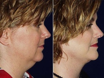 Liposuction of double chin and facelift before 6804