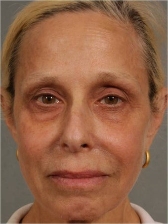 60 Year Old Female treated for under eye puffiness, sagging cheeks and frown lines non surgically after 640083