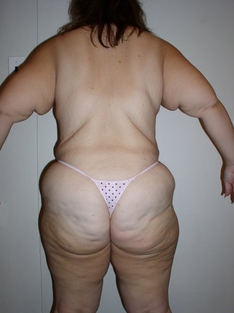 Contouring after massive weight loss before 167809
