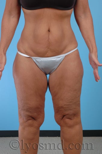 Lower Body Lift, Inner Thigh Lift before 255912