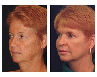 Lower Face and Neck Lift before 355084