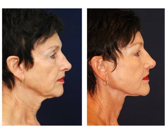 Lower Face and Neck Lift before 355125