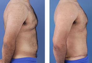 Tummy tuck on a male age 24 after 6728