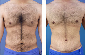 Tummy tuck on a male age 24 before 6728