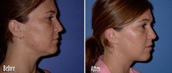 Mesotherapy to chin and jaw line before 6515
