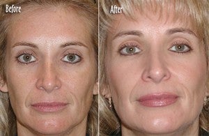 Microdermabrasion Full Face before 6389