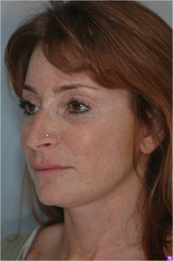 Facelift, Mini-Facelift, Endoscopic Midface Lift, Endoscopic Forehead Lift