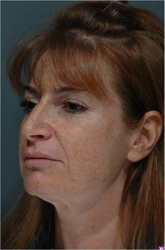 Facelift, Mini-Facelift, Endoscopic Midface Lift, Endoscopic Forehead Lift